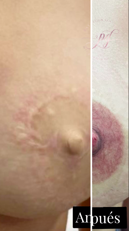 Micropigmentacion de areola y pezon Especialistas Ella s Spa Beauty